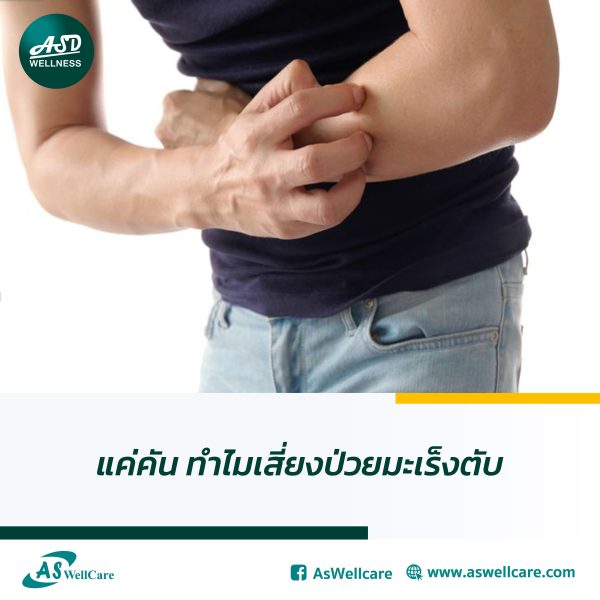 แค่คัน ทำไมเสี่ยงป่วยมะเร็งตับ