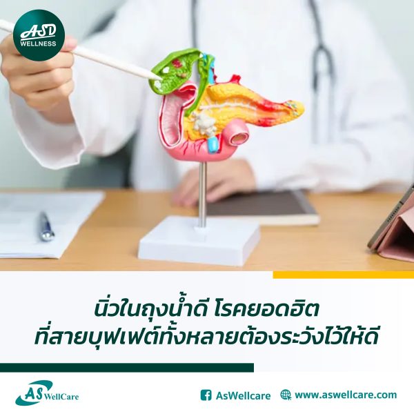 นิ่วในถุงน้ำดี โรคยอดฮิตที่สายบุฟเฟต์ทั้งหลายต้องระวังไว้ให้ดี