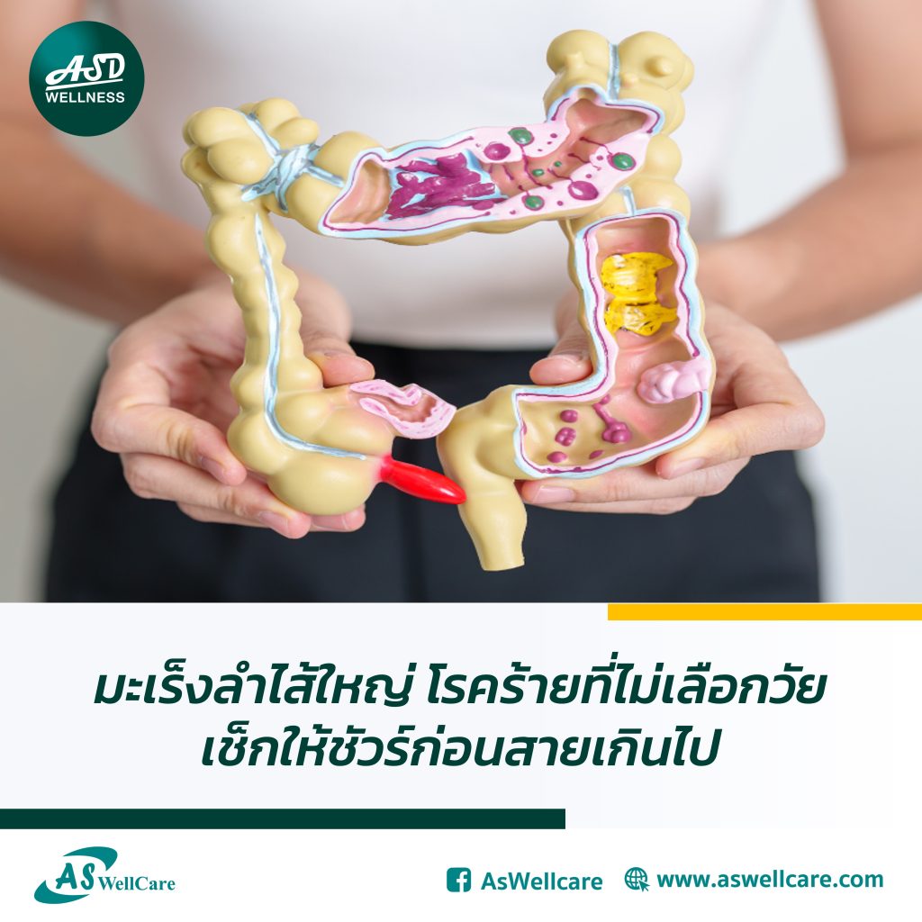 มะเร็งลำไส้ใหญ่ โรคร้ายที่ไม่เลือกวัย เช็กให้ชัวร์ก่อนสายเกินไป